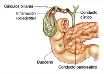 inflammed gallbladder with stones