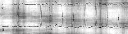Atrial fibrillation with rapid ventricular response