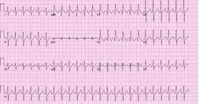 ST segment elevation
